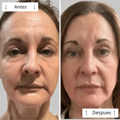 Máscara de contorno LED DERMALUX  | Piel perfecta en 30 días