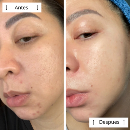 Máscara de contorno LED DERMALUX  | Piel perfecta en 30 días