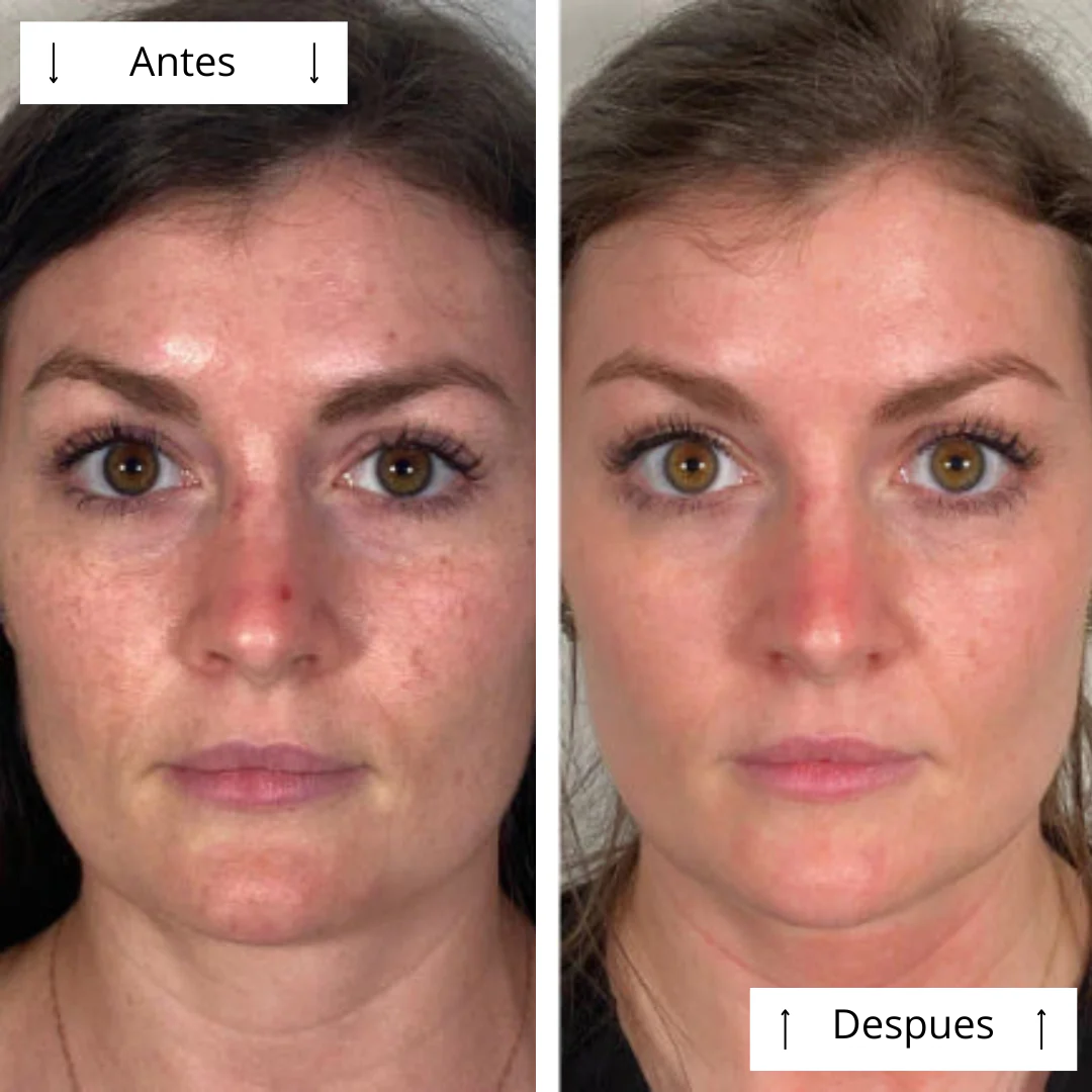 Máscara de contorno LED DERMALUX  | Piel perfecta en 30 días