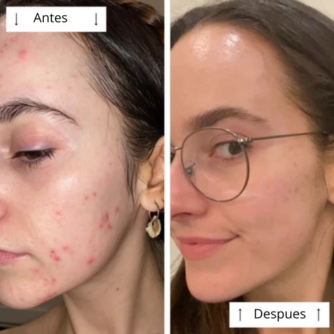 Máscara de contorno LED DERMALUX  | Piel perfecta en 30 días